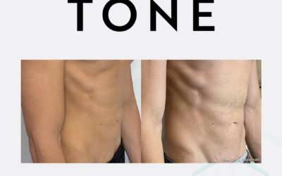 Tone Body Contouring